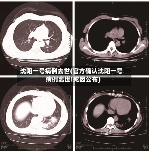 沈阳一号病例去世(官方确认沈阳一号病例离世!死因公布)-第1张图片